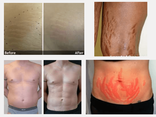 Laser Stretch Mark Removal: The Advanced Way of Removing ...