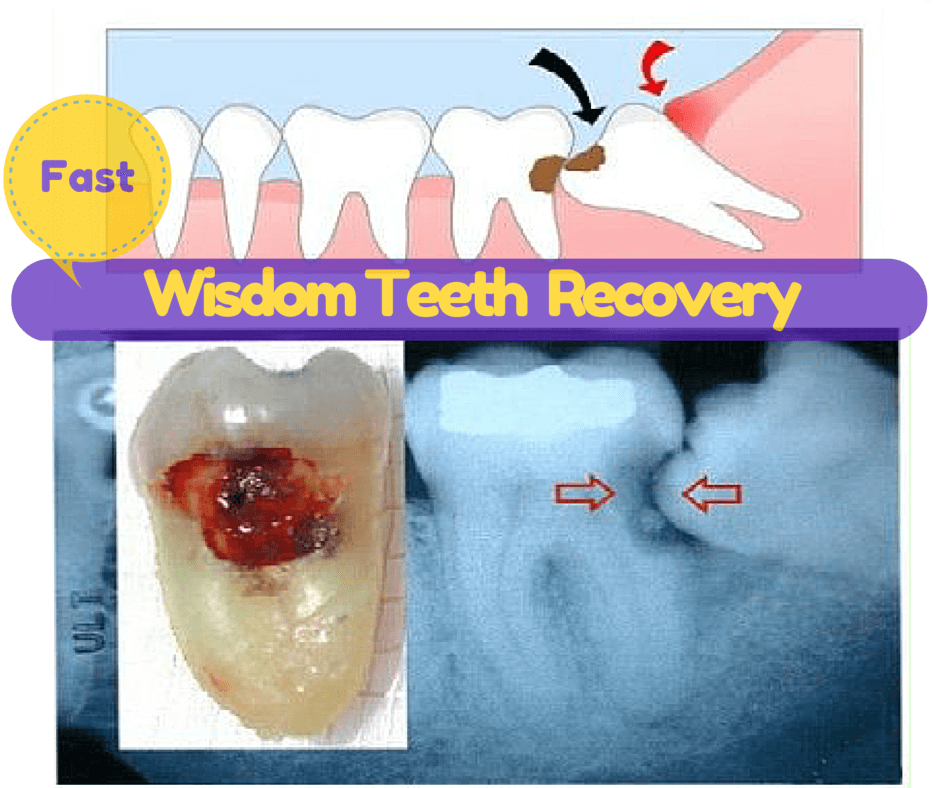 Wisdom Teeth Recovery Tip, Foods, 1st, 2nd 3rd Day
